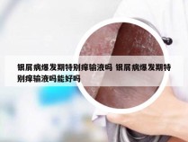银屑病爆发期特别痒输液吗 银屑病爆发期特别痒输液吗能好吗