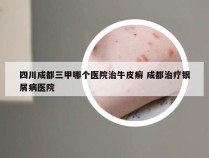 四川成都三甲哪个医院治牛皮癣 成都治疗银屑病医院