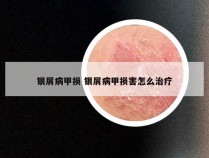 银屑病甲损 银屑病甲损害怎么治疗