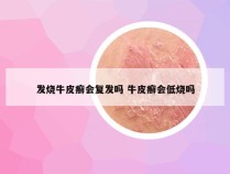 发烧牛皮癣会复发吗 牛皮癣会低烧吗
