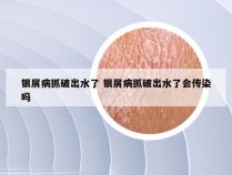 银屑病抓破出水了 银屑病抓破出水了会传染吗