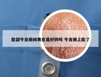 脸部牛皮癣掉黄皮是好转吗 牛皮癣上脸了