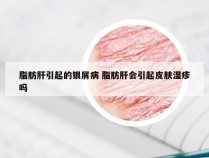 脂肪肝引起的银屑病 脂肪肝会引起皮肤湿疹吗