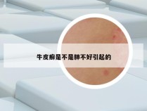 牛皮癣是不是肺不好引起的
