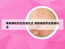 银屑病吃药还在冒红点 银屑病涂药还是有红点