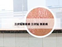 三伏贴银屑病 三伏贴 银屑病