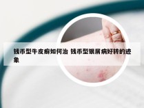 钱币型牛皮癣如何治 钱币型银屑病好转的迹象