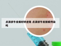 点滴状牛皮癣好转迹象 点滴状牛皮肤癣传染吗