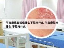 牛皮癣患者能吃什么不能吃什么 牛皮癣能吃什么,不能吃什么