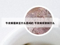 牛皮癣是缺乏什么造成的 牛皮癣皮肤缺什么
