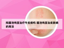陈醋泡鸡蛋治疗牛皮癣吗 醋泡鸡蛋治皮肤病的用法