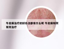 牛皮癣治疗的好办法都有什么呢 牛皮癣如何有效治疗