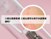 二硫化西银屑病 二硫化硒可以用于头部银屑病吗?