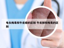 龟头梅毒和牛皮癣的区别 牛皮鲜和梅毒的区别