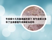 牛皮癣十几年越来越厉害了 有牛皮癣10多年了全身都是牛皮癣能治愈吗