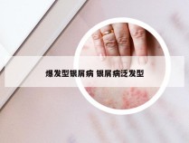 爆发型银屑病 银屑病泛发型