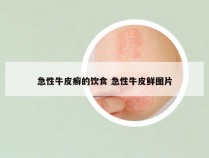 急性牛皮癣的饮食 急性牛皮鲜图片