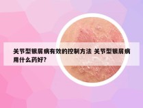 关节型银屑病有效的控制方法 关节型银屑病用什么药好?