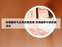玫瑰糠疹与点滴状银屑病 玫瑰糠疹与银屑病误诊