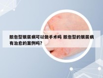 脓包型银屑病可以做手术吗 脓包型的银屑病有治愈的案例吗?