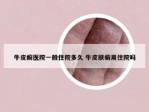 牛皮癣医院一般住院多久 牛皮肤癣用住院吗