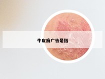牛皮癣广告是指