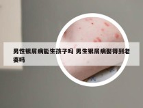 男性银屑病能生孩子吗 男生银屑病娶得到老婆吗