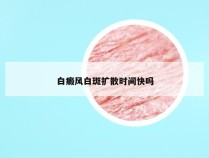 白癜风白斑扩散时间快吗