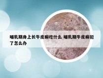 哺乳期身上长牛皮癣吃什么 哺乳期牛皮癣犯了怎么办