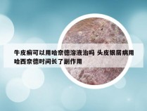 牛皮癣可以用哈奈德溶液治吗 头皮银屑病用哈西奈德时间长了副作用