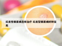 红皮性银屑病怎样治疗 红皮型银屑病好转征兆