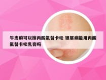 牛皮癣可以擦丙酸氟替卡松 银屑病能用丙酸氟替卡松乳膏吗