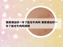 银屑病治好一年了能吃牛肉吗 银屑病治好一年了能吃牛肉吗视频