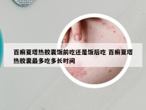 百癣夏塔热胶囊饭前吃还是饭后吃 百癣夏塔热胶囊最多吃多长时间