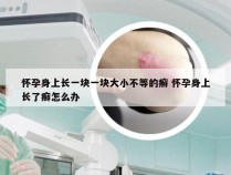 怀孕身上长一块一块大小不等的癣 怀孕身上长了癣怎么办