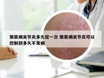 银屑病关节炎多久犯一次 银屑病关节炎可以控制到多久不发病