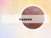 牛皮癣初发状