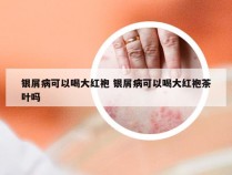 银屑病可以喝大红袍 银屑病可以喝大红袍茶叶吗