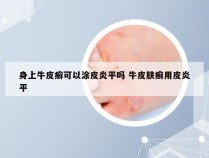 身上牛皮癣可以涂皮炎平吗 牛皮肤癣用皮炎平