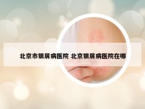 北京市银屑病医院 北京银屑病医院在哪