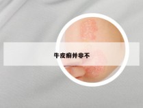 牛皮癣并非不