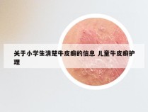关于小学生清楚牛皮癣的信息 儿童牛皮癣护理
