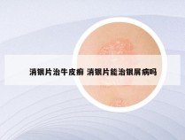 消银片治牛皮癣 消银片能治银屑病吗
