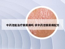 中药泡能治疗银屑病吗 求中药泡银屑病配方