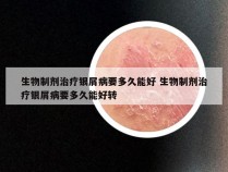 生物制剂治疗银屑病要多久能好 生物制剂治疗银屑病要多久能好转