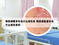 银屑病要多补充什么维生素 银屑病患者补充什么维生素好