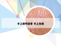 手上癣咋回事 手上有癣