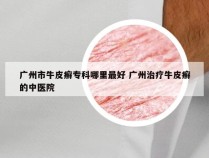 广州市牛皮癣专科哪里最好 广州治疗牛皮癣的中医院