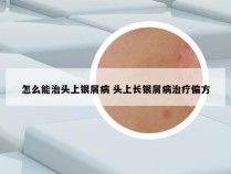 怎么能治头上银屑病 头上长银屑病治疗偏方