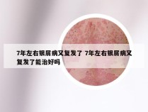 7年左右银屑病又复发了 7年左右银屑病又复发了能治好吗